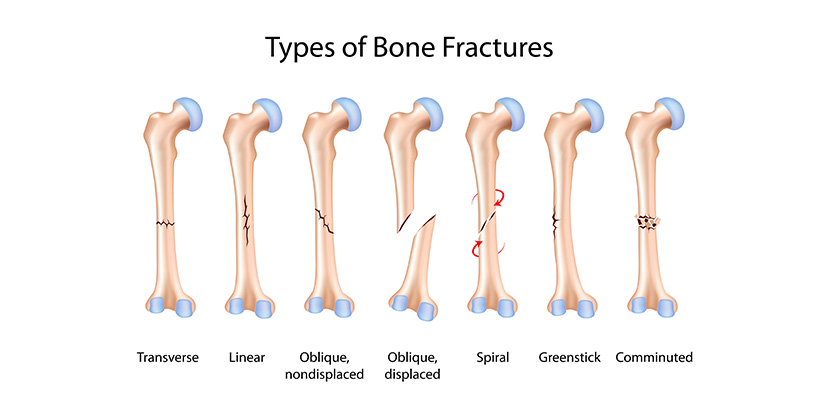κατάγματα οστών